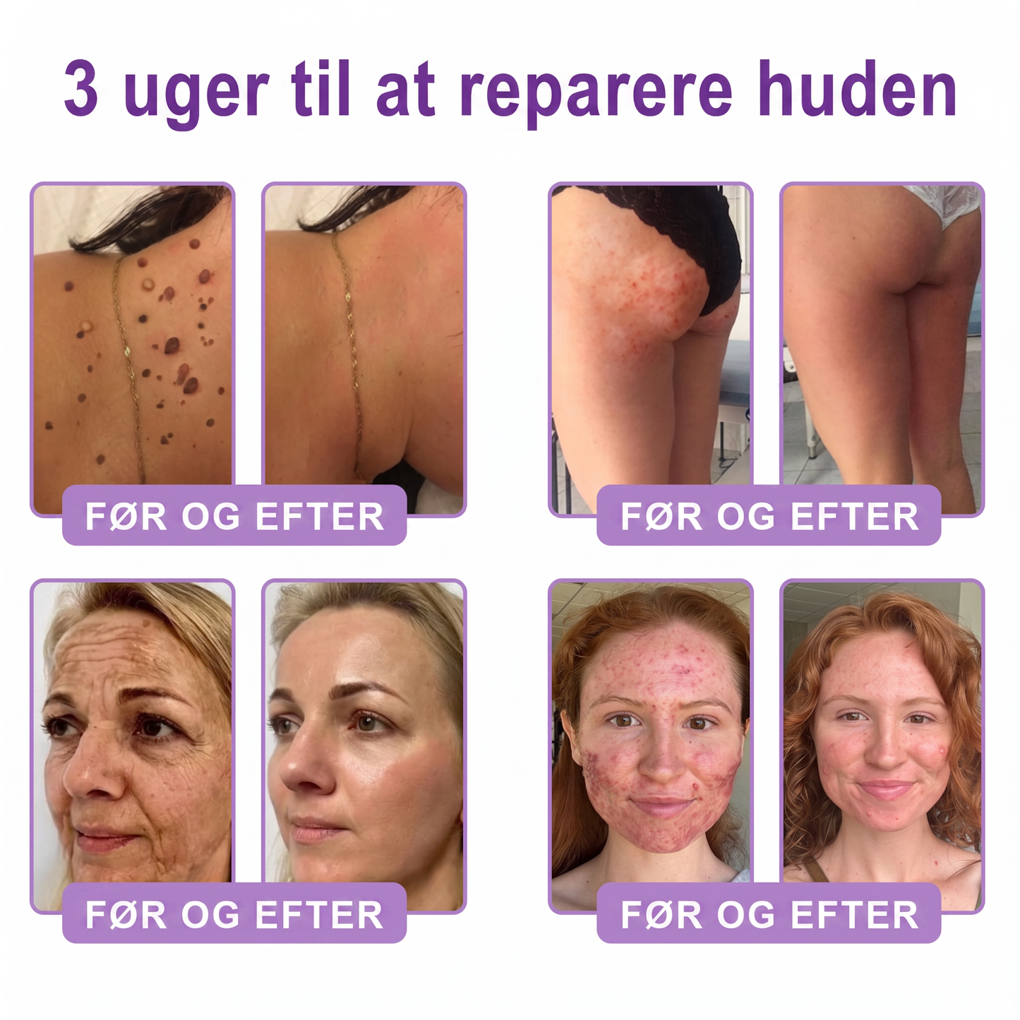 💎 Vitalisys ® PDRN Multi-Peptid Massage Kropsrullecreme - Anti-aldring, fugtgivende, hudstramning og løft, genopretter hudens tilstand, jævner hudtonen, behandling af akne og mørke pletter, fjerner vorter samt lindrer mod rødme og psoriasis.