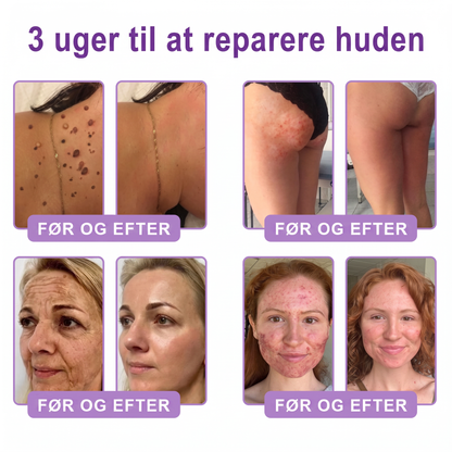 💎 Vitalisys ® PDRN Multi-Peptid Massage Kropsrullecreme - Anti-aldring, fugtgivende, hudstramning og løft, genopretter hudens tilstand, jævner hudtonen, behandling af akne og mørke pletter, fjerner vorter samt lindrer mod rødme og psoriasis.