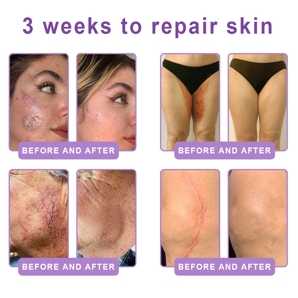 💎Vitalisys® PDRN Multi-Peptide Massaging Body Roller Cream- Anti-aging, Hydrating, Skin Firming & Lifting, Skin Repair, Even Tone, Acne and Dark Spot Treatment, Wart and Mole Removal, and Psoriasis Relief.
