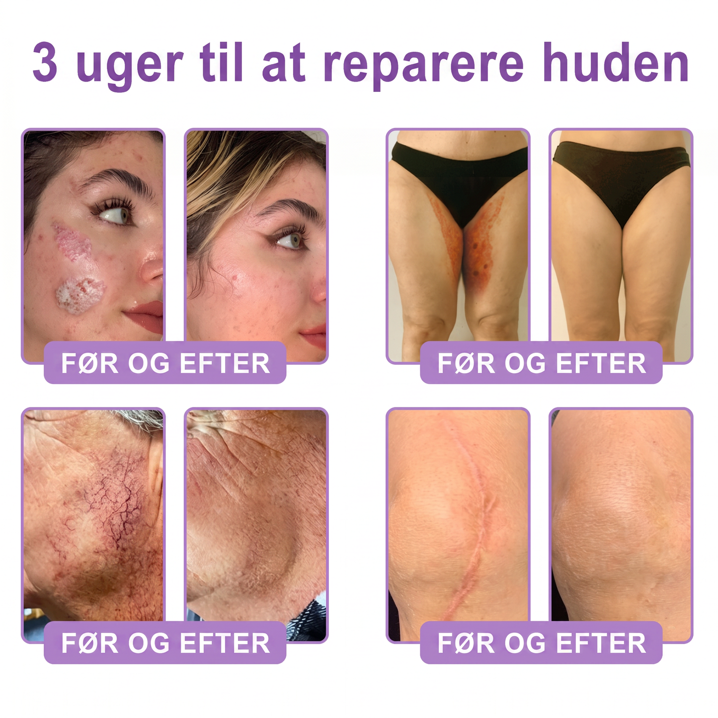 💎 Vitalisys ® PDRN Multi-Peptid Massage Kropsrullecreme - Anti-aldring, fugtgivende, hudstramning og løft, genopretter hudens tilstand, jævner hudtonen, behandling af akne og mørke pletter, fjerner vorter samt lindrer mod rødme og psoriasis.