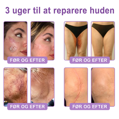 💎 Vitalisys ® PDRN Multi-Peptid Massage Kropsrullecreme - Anti-aldring, fugtgivende, hudstramning og løft, genopretter hudens tilstand, jævner hudtonen, behandling af akne og mørke pletter, fjerner vorter samt lindrer mod rødme og psoriasis.